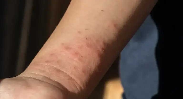 bed bug bites asheville nc
