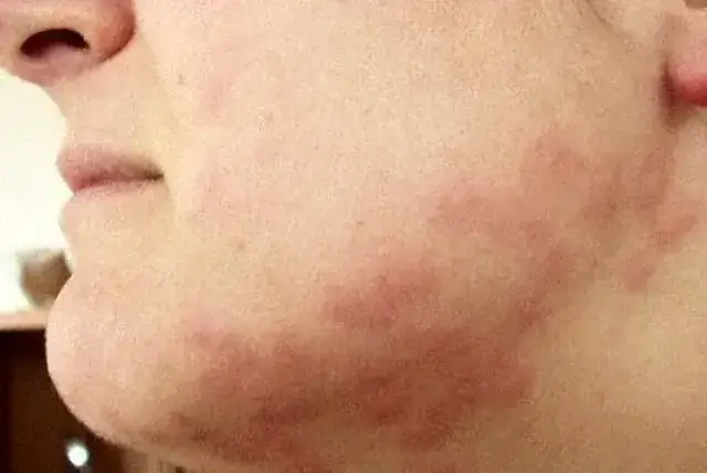 boone bed bug extermination